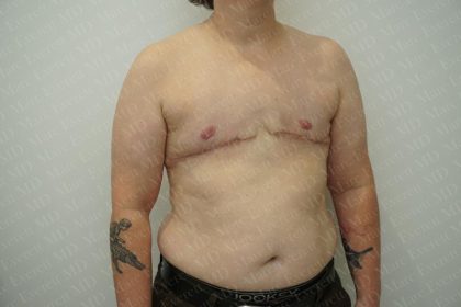 Chest Masculinization Surgery Before & After Patient #3251