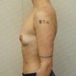 Chest Masculinization Surgery Before & After Patient #3237