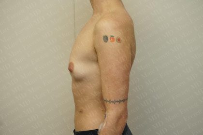 Chest Masculinization Surgery Before & After Patient #3237