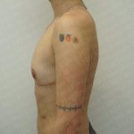 Chest Masculinization Surgery Before & After Patient #3237