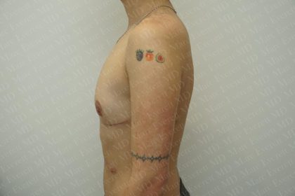 Chest Masculinization Surgery Before & After Patient #3237