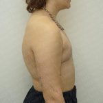 Chest Masculinization Surgery Before & After Patient #3244