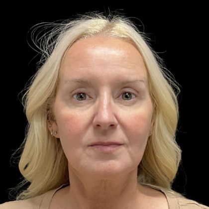 Before & After Patient #3756