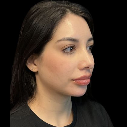Before & After Patient #3787