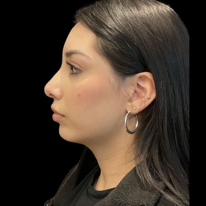 Before & After Patient #3787