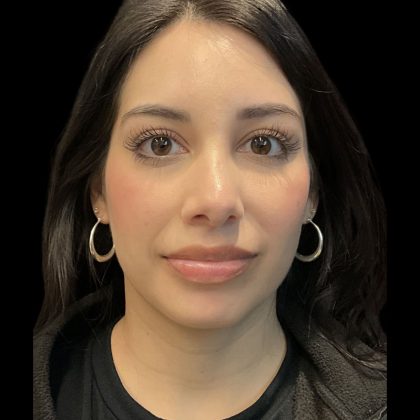 Before & After Patient #3787
