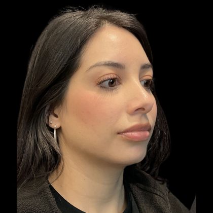 Before & After Patient #3787