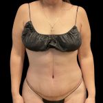 Abdominoplasty Before & After Patient #3794