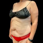 Abdominoplasty Before & After Patient #3794
