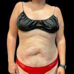 Abdominoplasty Before & After Patient #3794