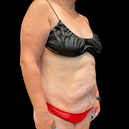 Abdominoplasty Before & After Patient #3794