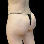Brazilian Butt Lift (Fat Transfer to the Buttocks) Before & After Patient #3771