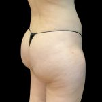 Brazilian Butt Lift (Fat Transfer to the Buttocks) Before & After Patient #3771