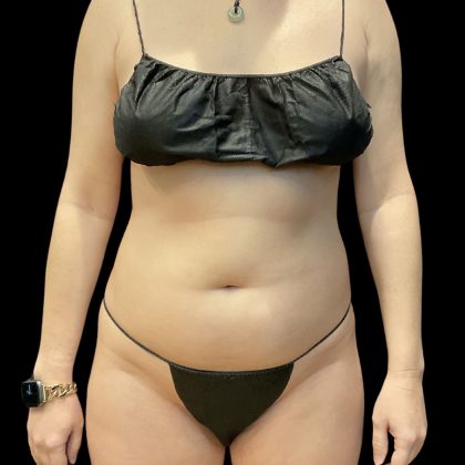 Brazilian Butt Lift (Fat Transfer to the Buttocks) Before & After Patient #3771