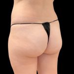 Brazilian Butt Lift (Fat Transfer to the Buttocks) Before & After Patient #3771