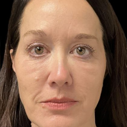 Before & After Patient #3780