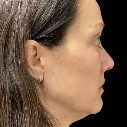 Before & After Patient #3780