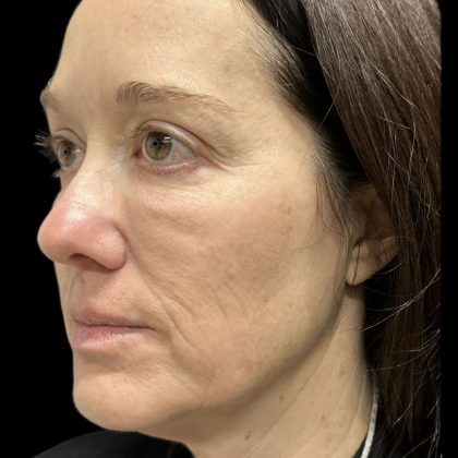 Before & After Patient #3780