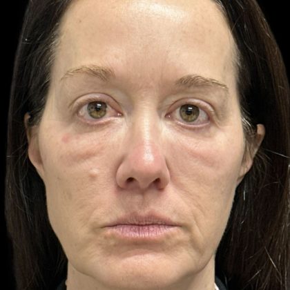 Before & After Patient #3780