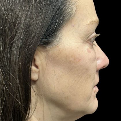 Before & After Patient #3780