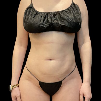Brazilian Butt Lift (Fat Transfer to the Buttocks) Before & After Patient #3771