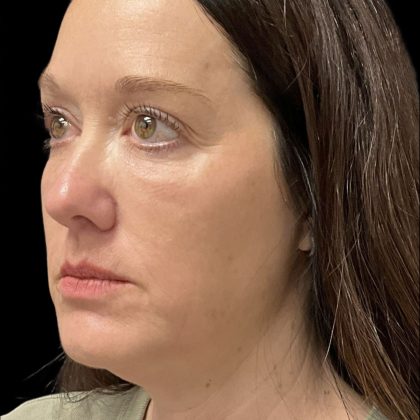 Before & After Patient #3780