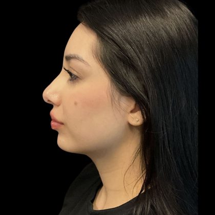 Before & After Patient #3787