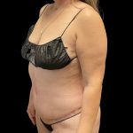 Abdominoplasty Before & After Patient #3794