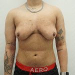 Chest Masculinization Surgery Before & After Patient #3951