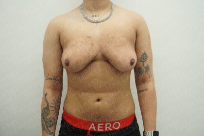 Chest Masculinization Surgery Before & After Patient #3951