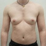Chest Masculinization Surgery Before & After Patient #3952