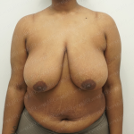 Breast Reduction Before & After Patient #3861