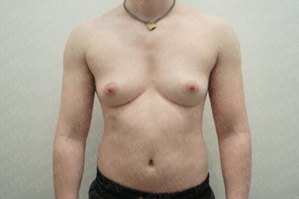 Chest Masculinization Surgery Before & After Patient #3952