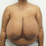 Breast Reduction Before & After Patient #3862