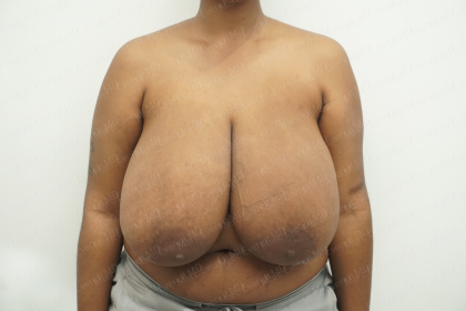 Breast Reduction Before & After Patient #3862