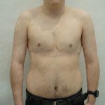 Chest Masculinization Surgery Before & After Patient #3950