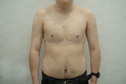 Chest Masculinization Surgery Before & After Patient #3950