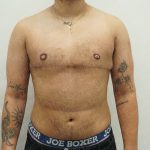 Chest Masculinization Surgery Before & After Patient #3951