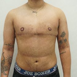 Chest Masculinization Surgery Before & After Patient #3951