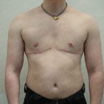 Chest Masculinization Surgery Before & After Patient #3952