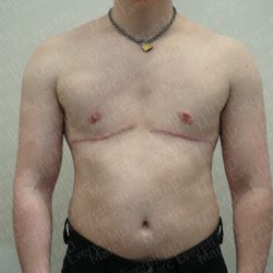 Chest Masculinization Surgery Before & After Patient #3952