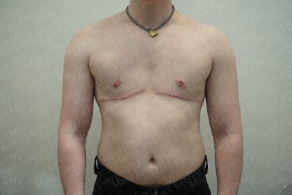 Chest Masculinization Surgery Before & After Patient #3952