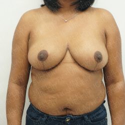 Breast Reduction Before & After Patient #3867