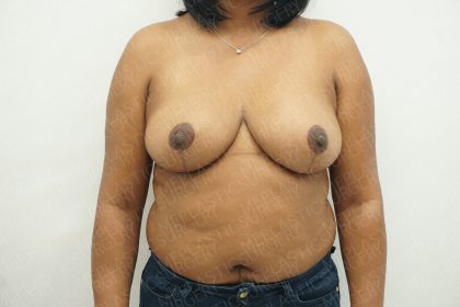 Breast Reduction Before & After Patient #3867