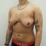 Chest Masculinization Surgery Before & After Patient #3951