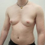 Chest Masculinization Surgery Before & After Patient #3952
