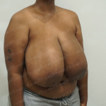 Breast Reduction Before & After Patient #3862