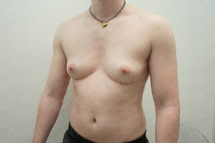 Chest Masculinization Surgery Before & After Patient #3952