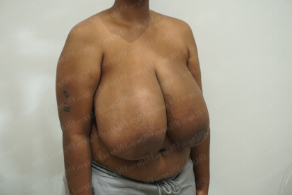 Breast Reduction Before & After Patient #3862