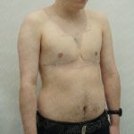 Chest Masculinization Surgery Before & After Patient #3950